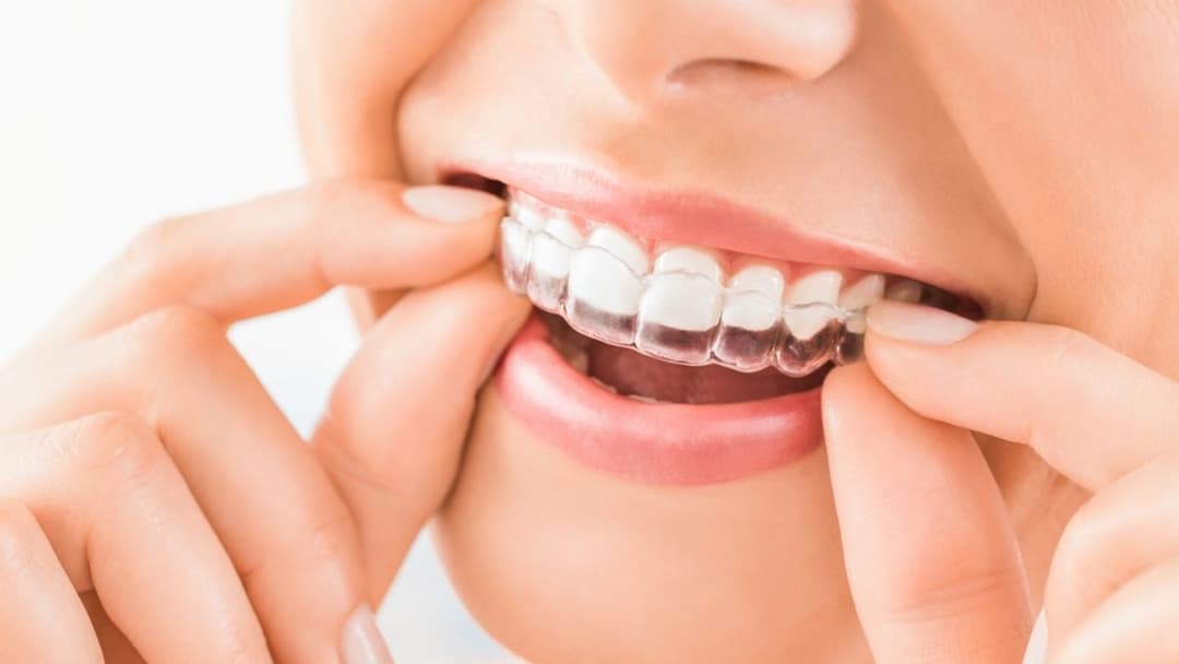 Pessoa usando alinhador dentário transparente Invisalign